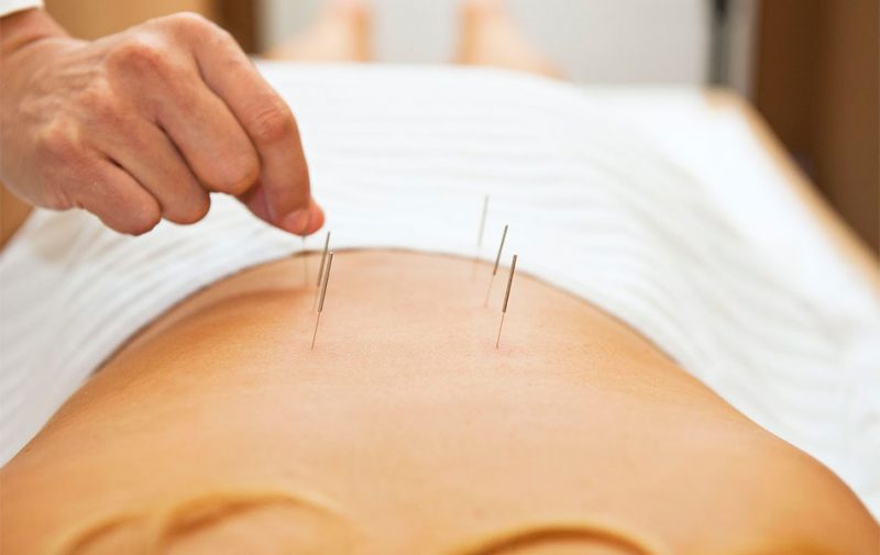 physical therapy, functional dry needling