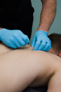 Dry Needling - Surge Mobile Physical Therapy