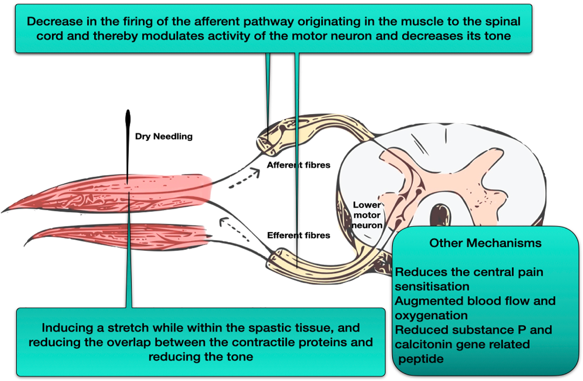 dry needle image